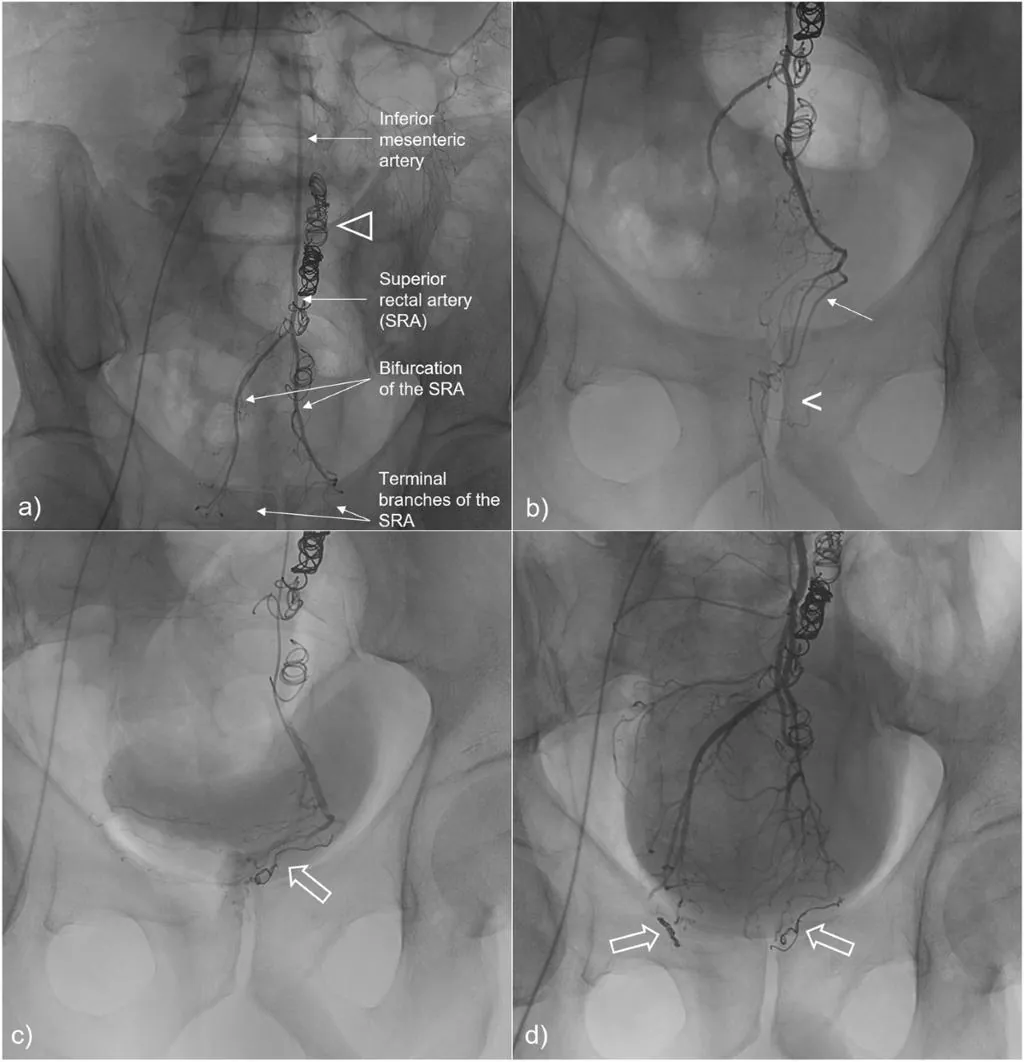 Four-panel angiogram from a hemorrhoid artery embolization, showing the inferior mesenteric and superior rectal arteries with embolization coils in place