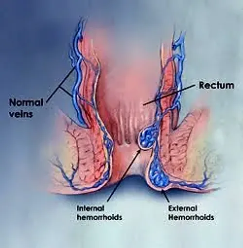 Illustration of rectal anatomy showing normal veins alongside internal and external hemorrhoids